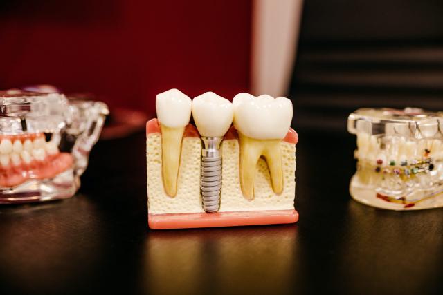 Dental Implant and CBCT